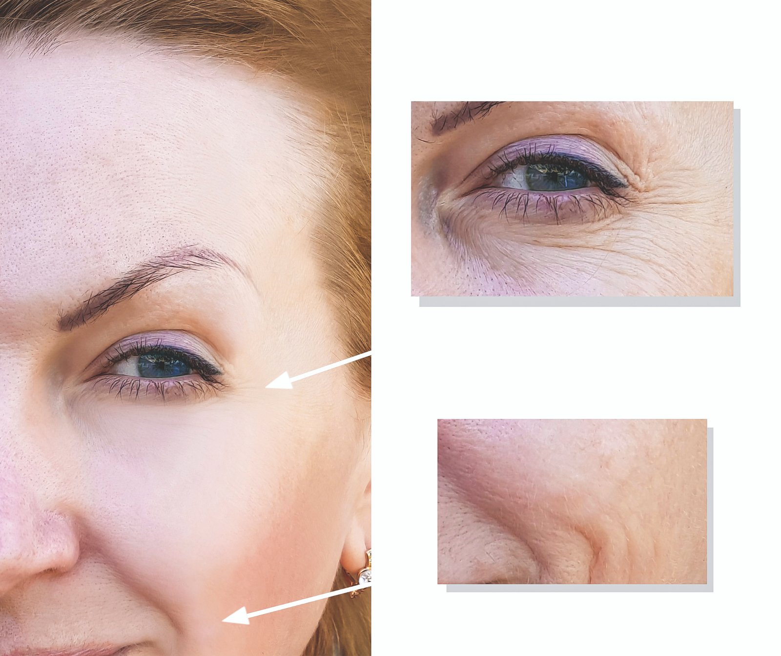 Trẻ hóa da bằng filler