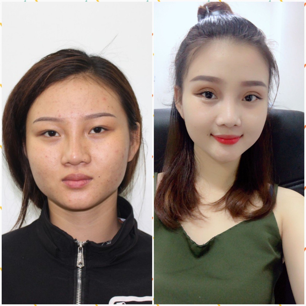 Cắt mắt 2 mí