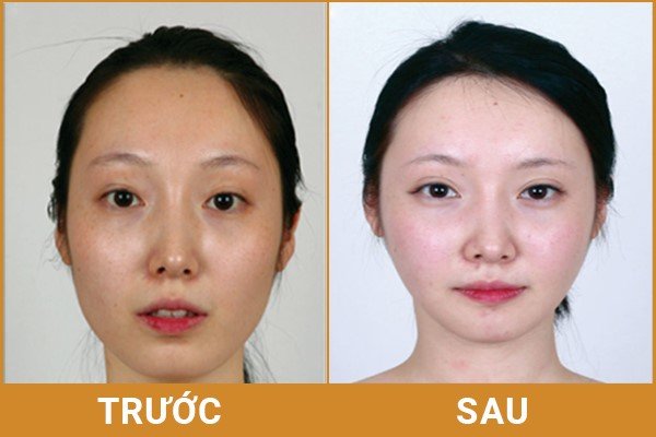 Mở rộng góc mắt - Mắt có nếp rẻ quạt