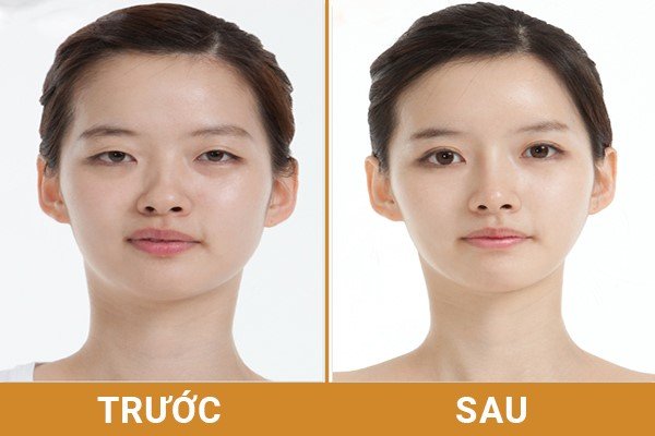 Mở rộng góc mắt - Mắt xếch ngược