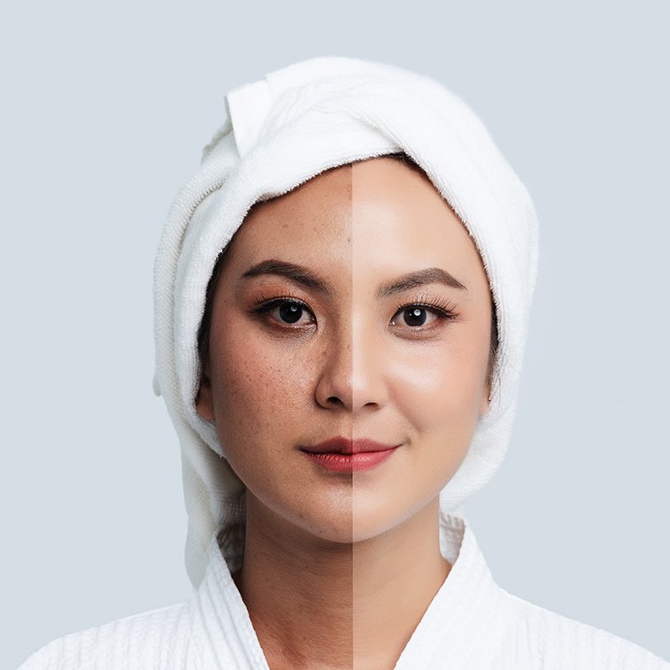 Điều trị nám