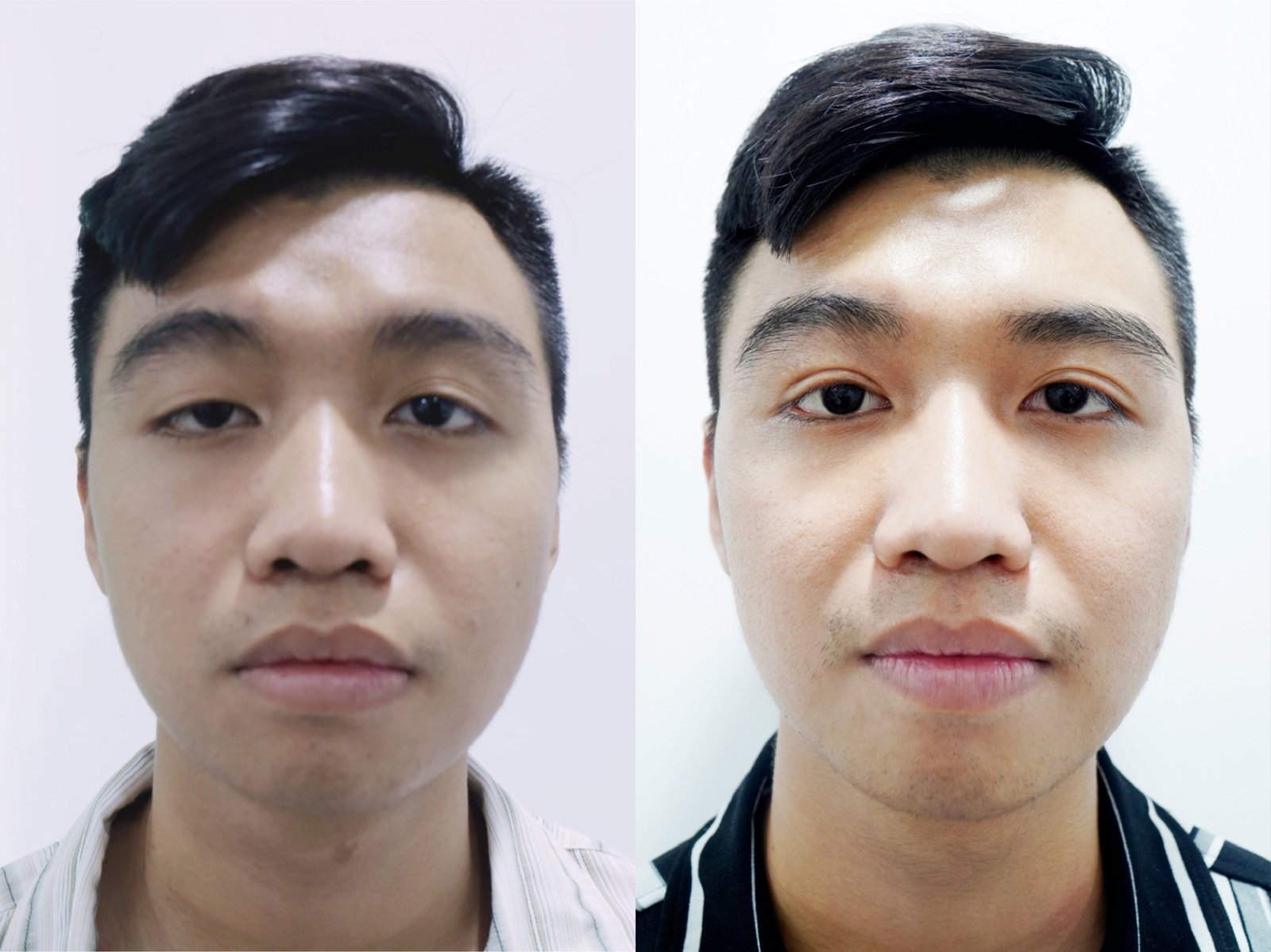 Chữa sụp mí mắt