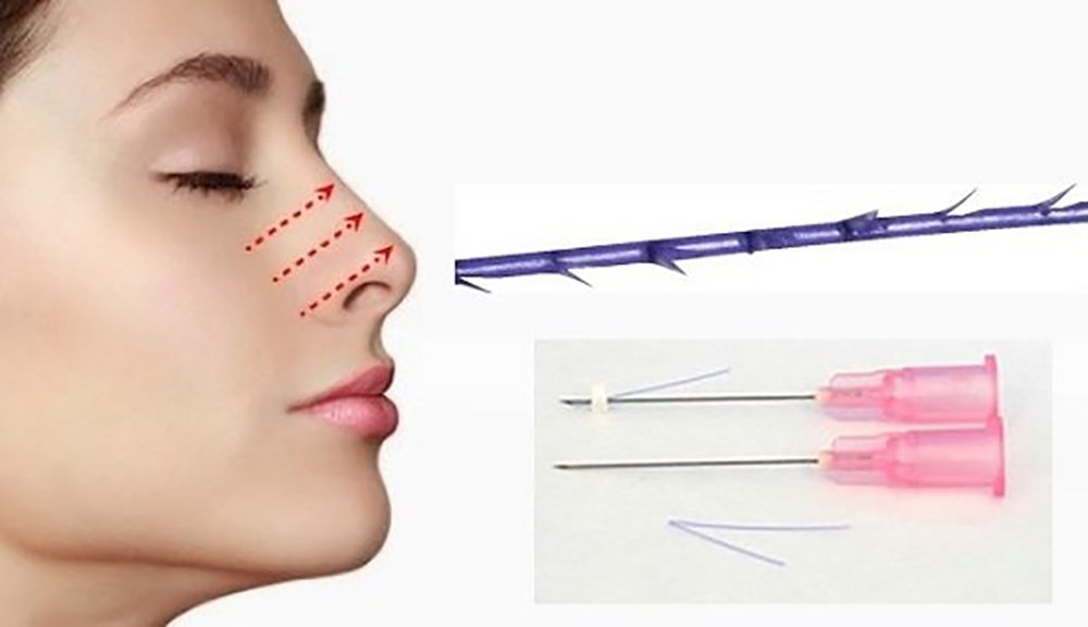 Nâng mũi bằng chỉ