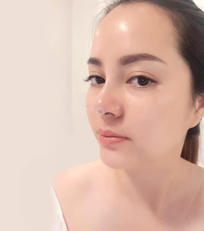 Nâng mũi bằng chỉ