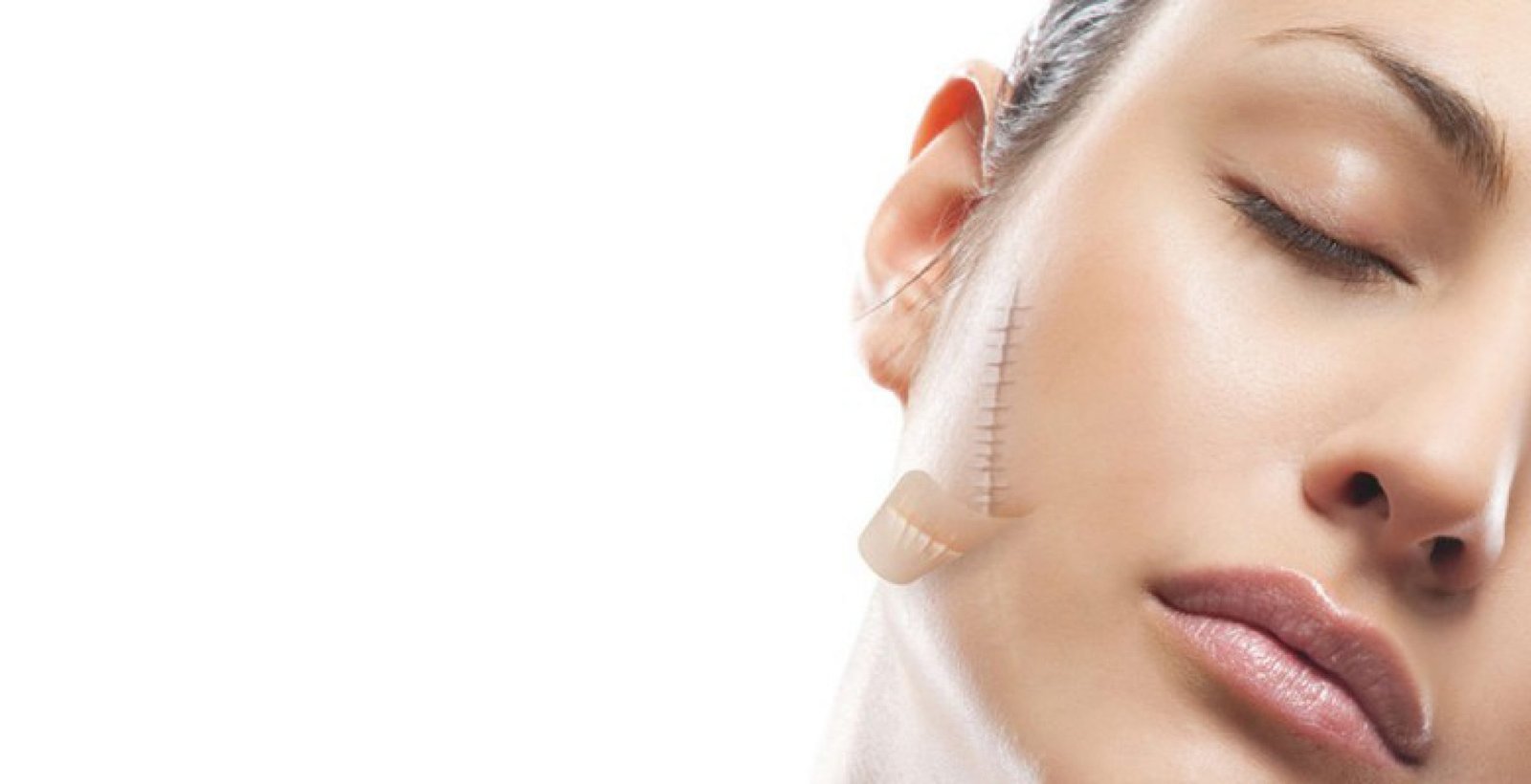 Điều trị sẹo lồi