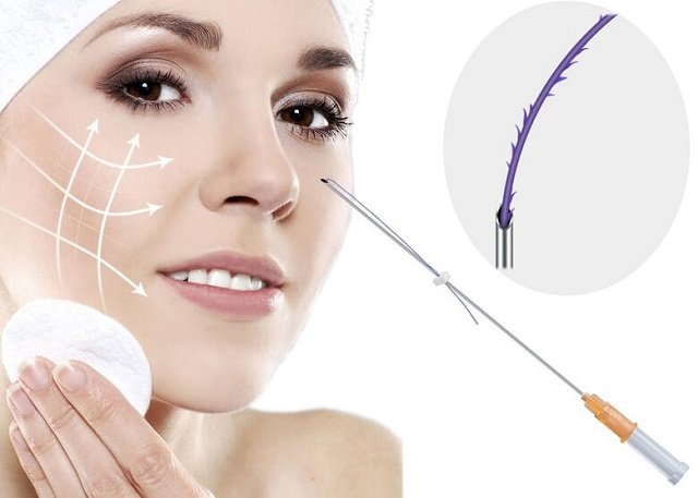 Nâng mũi bằng chỉ